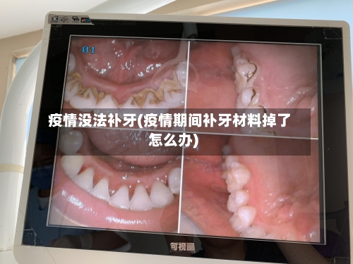 疫情没法补牙(疫情期间补牙材料掉了怎么办)-第1张图片